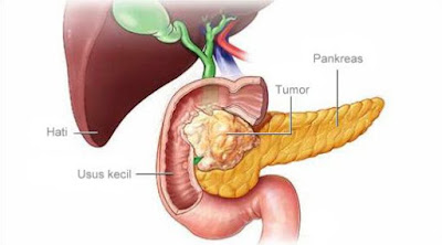 4 Cara Mencegah Kanker Pankreas, Simak Penjelasannya